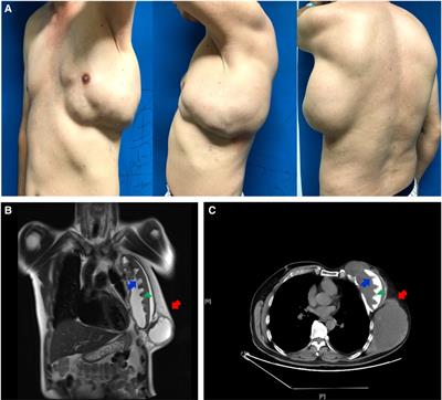 Frontiers Breast implant associated squamous cell carcinoma in a